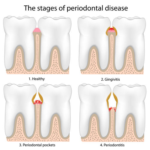 periodontitis.jpg - large