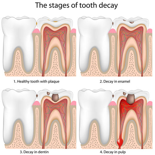 toothdecay.jpg - large