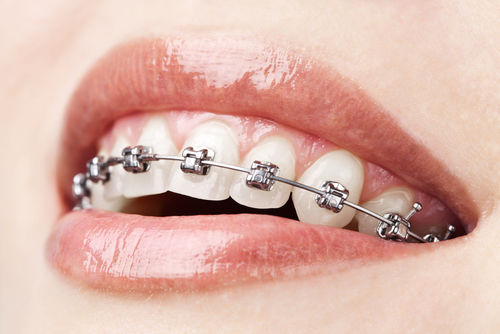 braces.jpg - large