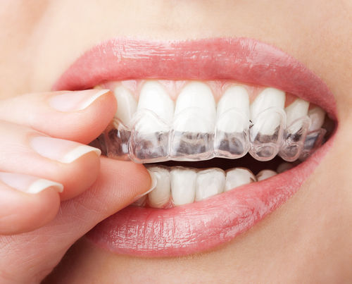 invisalign.jpg - large