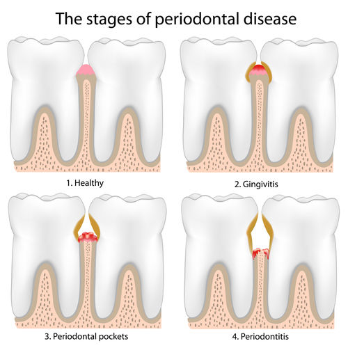 periodontitis.jpg - large