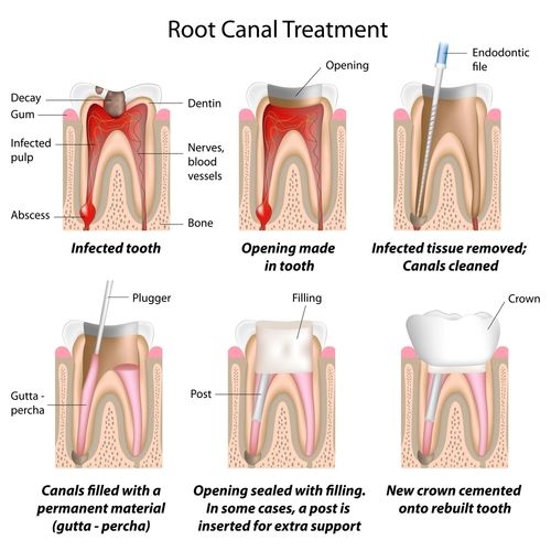 rootcanal.jpg - large